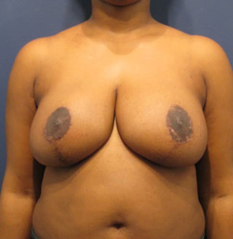 Breast Reduction Before & After Gallery - Patient 174149970 - Image 2