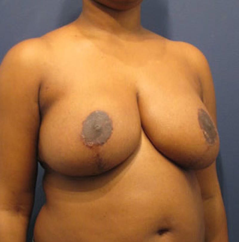 Breast Reduction Before & After Gallery - Patient 174149970 - Image 4