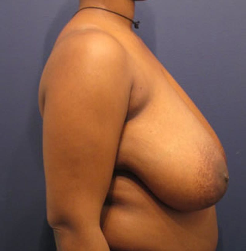 Breast Reduction Before & After Gallery - Patient 174149970 - Image 5