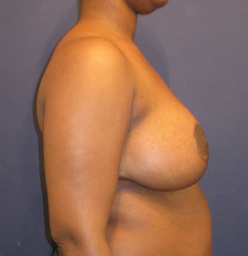 Breast Reduction Before & After Gallery - Patient 174149970 - Image 6