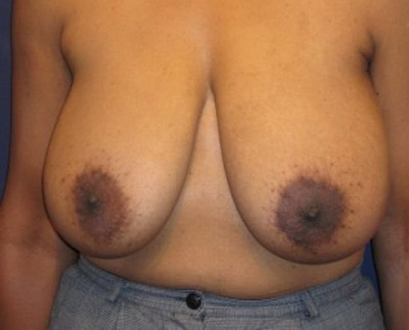Breast Reduction Before & After Gallery - Patient 174149975 - Image 1