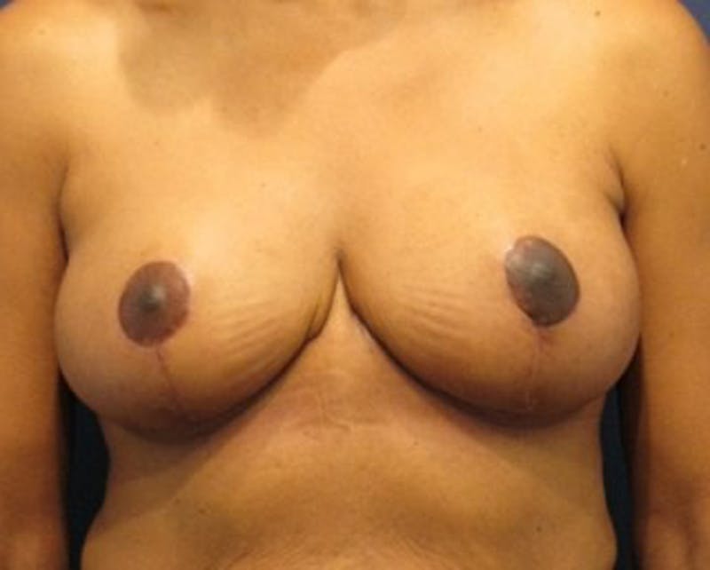 Breast Reduction Before & After Gallery - Patient 174149975 - Image 2
