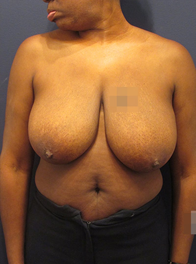 Breast Reduction Before & After Gallery - Patient 174149985 - Image 1