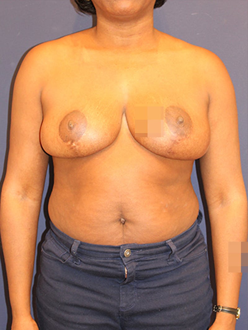 Breast Reduction Before & After Gallery - Patient 174149985 - Image 2