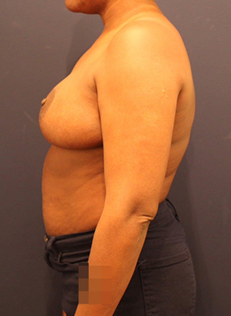 Breast Reduction Before & After Gallery - Patient 174149985 - Image 4