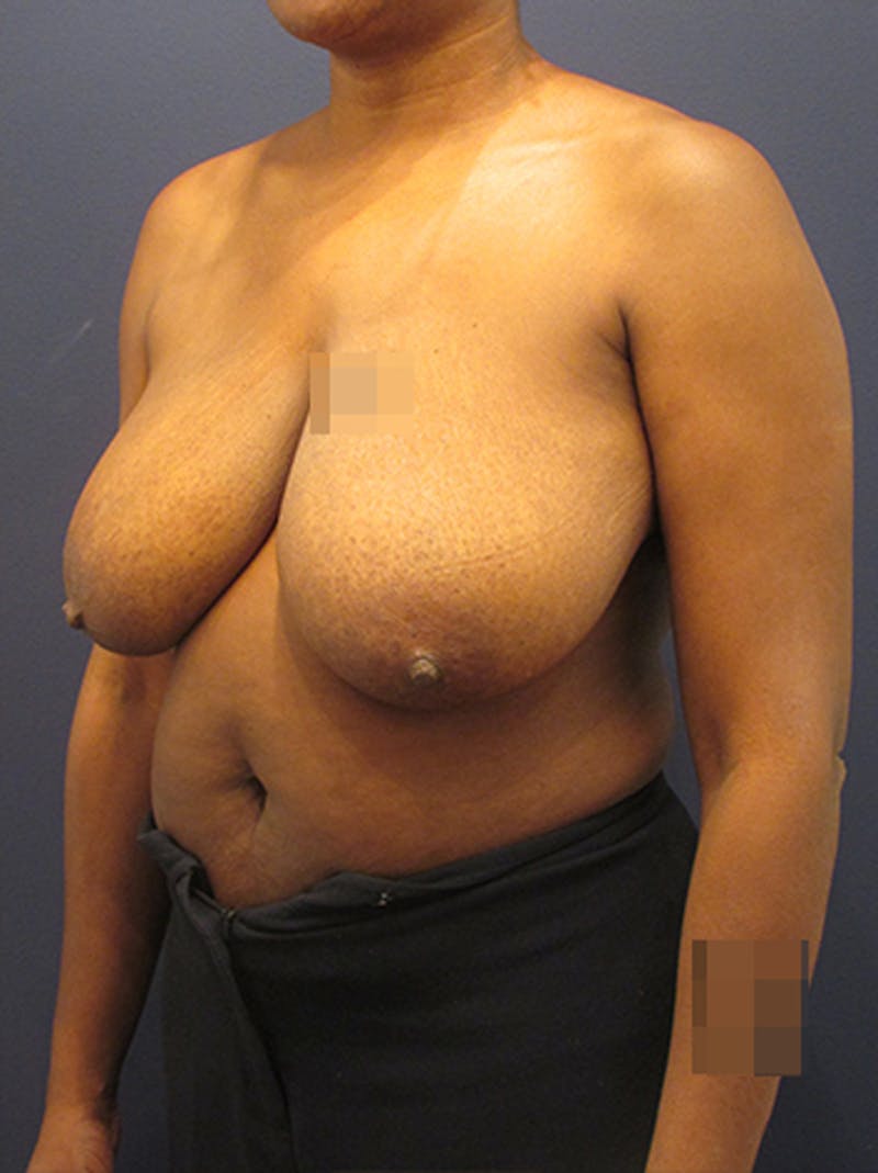 Breast Reduction Before & After Gallery - Patient 174149985 - Image 5