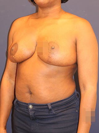 Breast Reduction Before & After Gallery - Patient 174149985 - Image 6