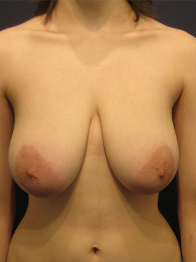Breast Reduction Before & After Gallery - Patient 174149995 - Image 1