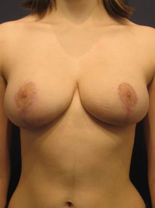 Breast Reduction Before & After Gallery - Patient 174149995 - Image 2