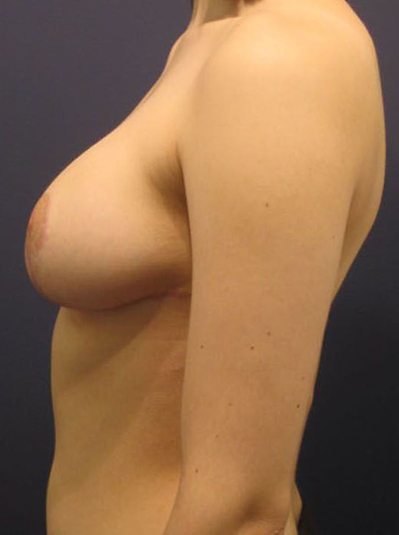 Breast Reduction Before & After Gallery - Patient 174149995 - Image 6