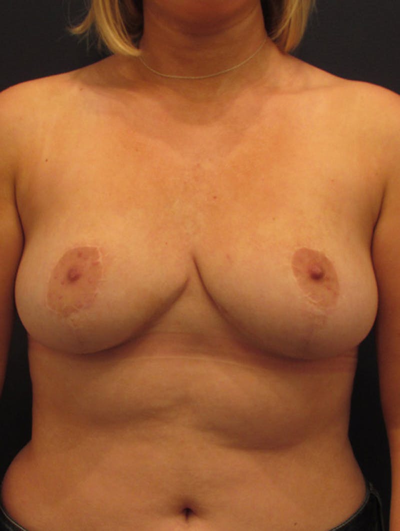 Breast Reduction Before & After Gallery - Patient 174150000 - Image 2