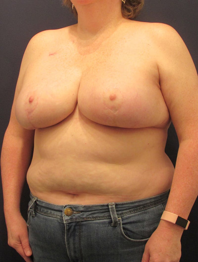 Breast Reduction Before & After Gallery - Patient 174150007 - Image 4