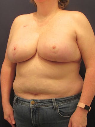 Breast Reduction Before & After Gallery - Patient 174150007 - Image 4
