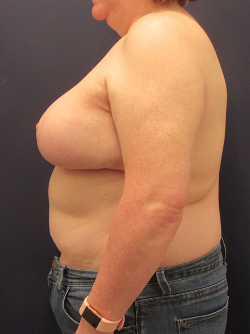 Breast Reduction Before & After Gallery - Patient 174150007 - Image 6