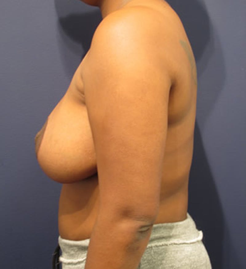 Breast Reduction Before & After Gallery - Patient 174150011 - Image 6