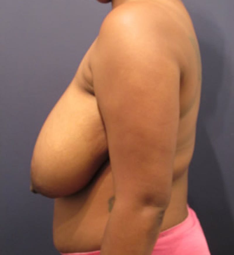 Breast Reduction Before & After Gallery - Patient 174150011 - Image 5