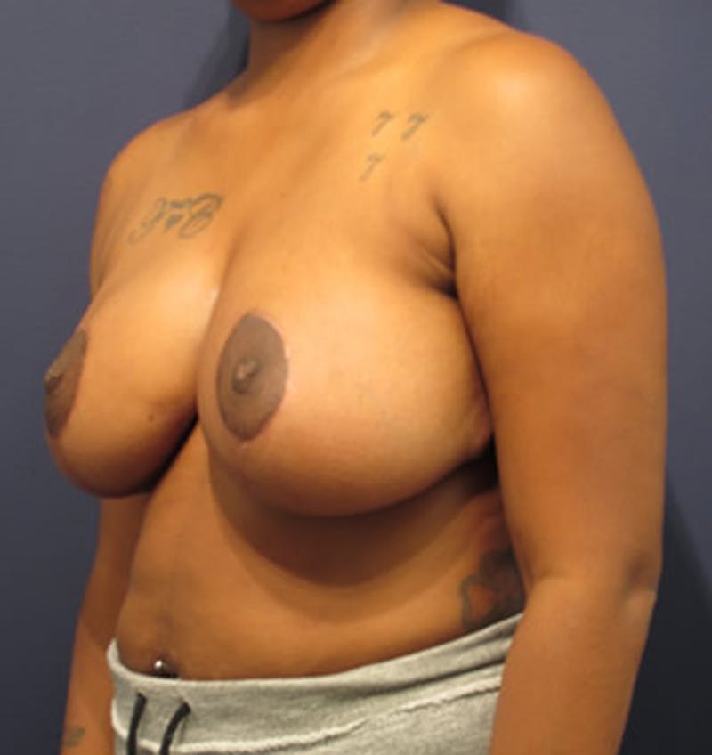 Breast Reduction Before & After Gallery - Patient 174150011 - Image 4