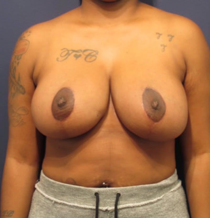Breast Reduction Before & After Gallery - Patient 174150011 - Image 2
