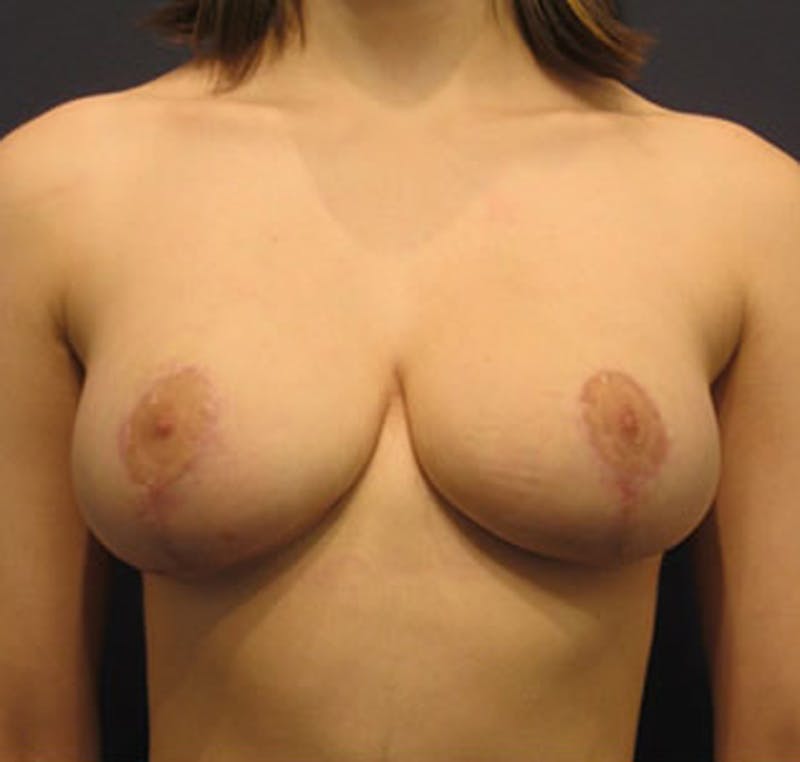 Breast Reduction Before & After Gallery - Patient 174150018 - Image 2