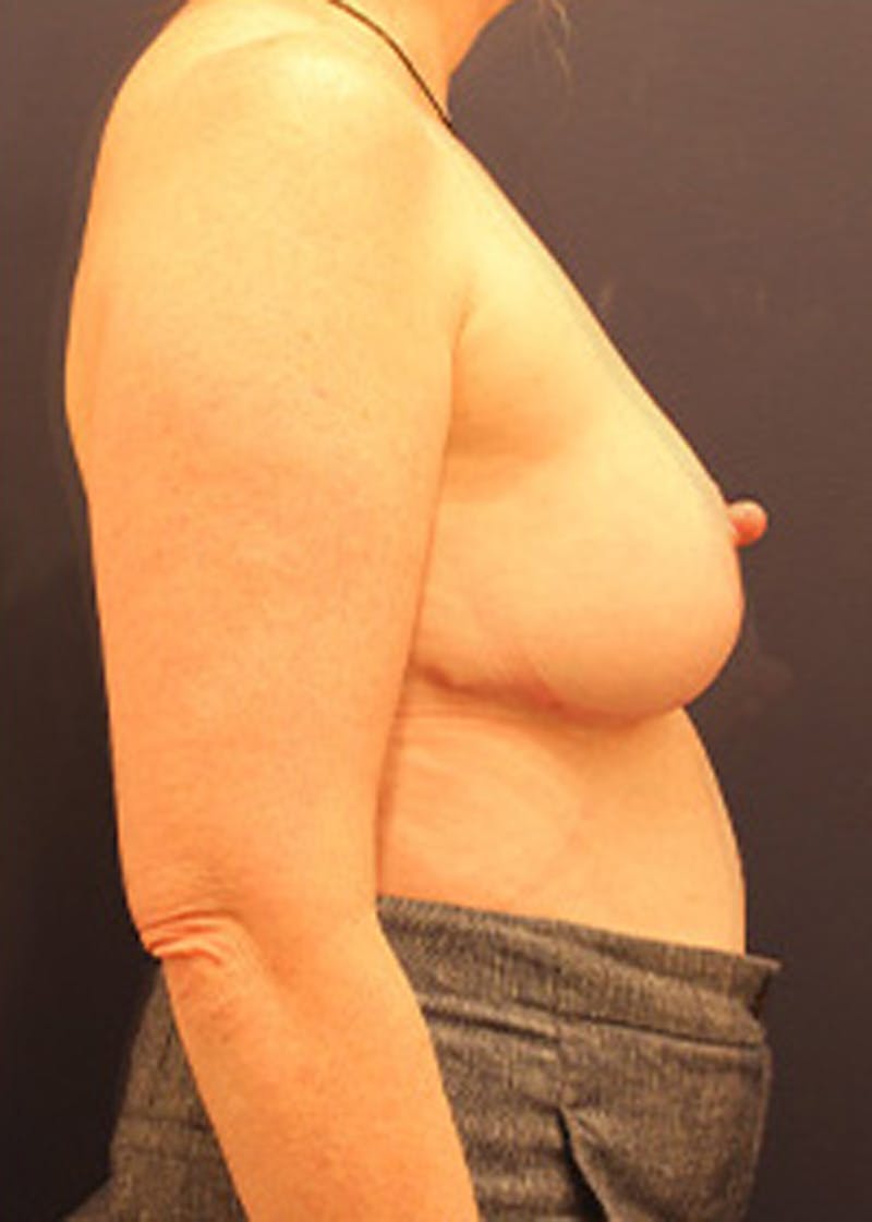 Breast Reduction Before & After Gallery - Patient 174150023 - Image 6
