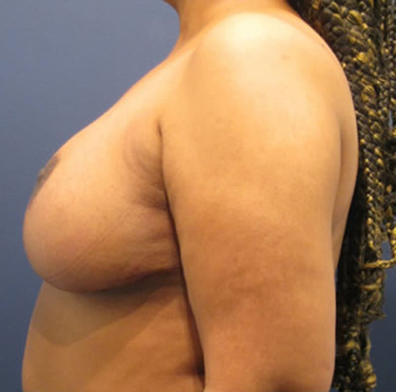 Breast Reduction Before & After Gallery - Patient 174150027 - Image 4