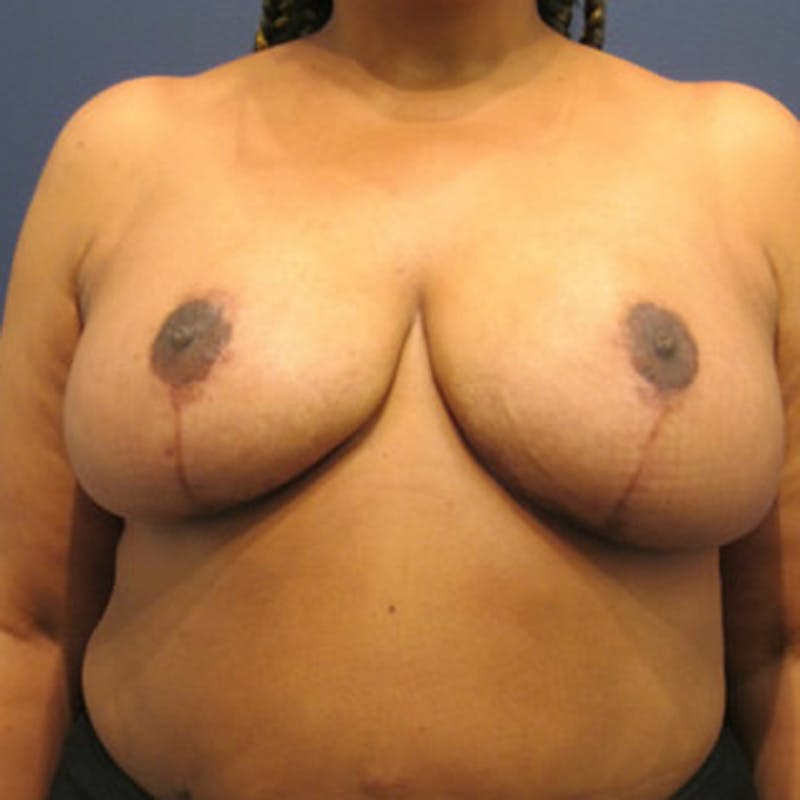 Breast Reduction Before & After Gallery - Patient 174150027 - Image 2