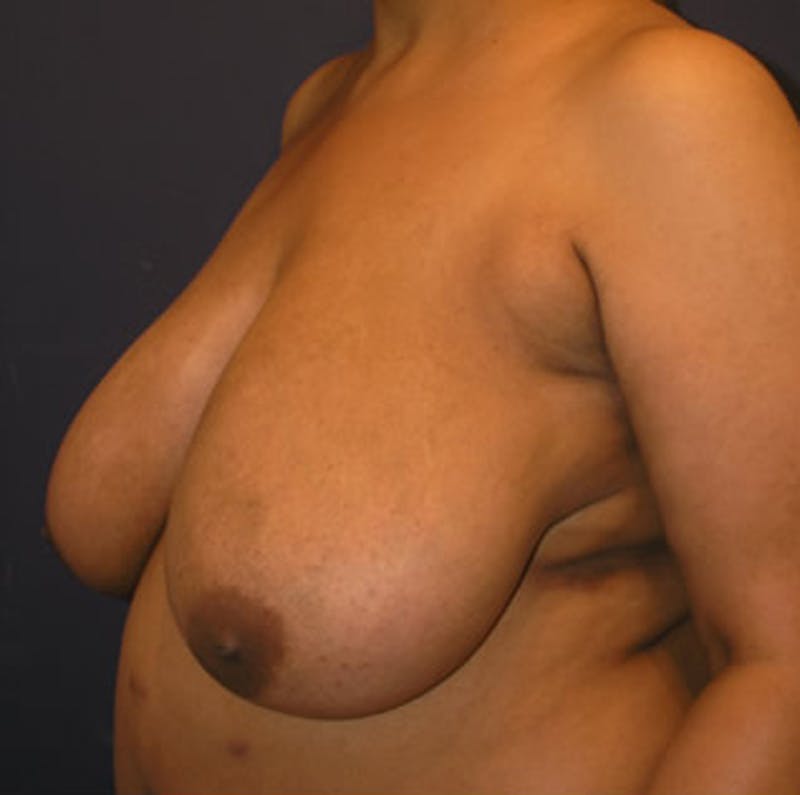 Breast Reduction Before & After Gallery - Patient 174150027 - Image 3