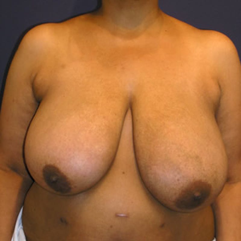Breast Reduction Before & After Gallery - Patient 174150027 - Image 1