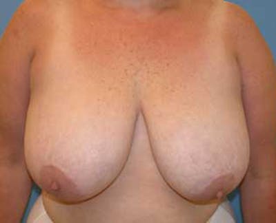Breast Reduction Before & After Gallery - Patient 174150030 - Image 1