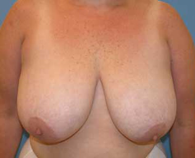 Breast Reduction Before & After Gallery - Patient 174150030 - Image 1