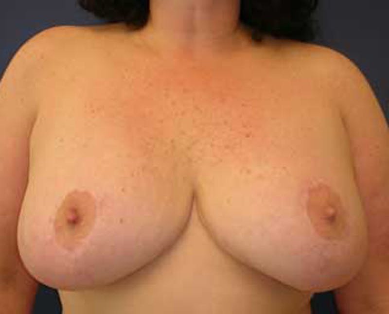 Breast Reduction Before & After Gallery - Patient 174150030 - Image 2