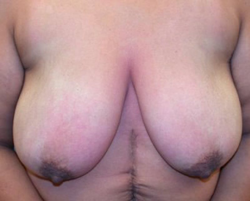 Breast Reduction Before & After Gallery - Patient 174150035 - Image 1
