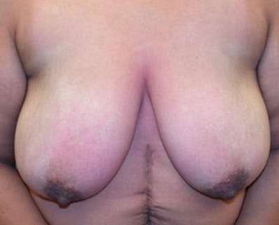 Breast Reduction Before & After Gallery - Patient 174150035 - Image 1