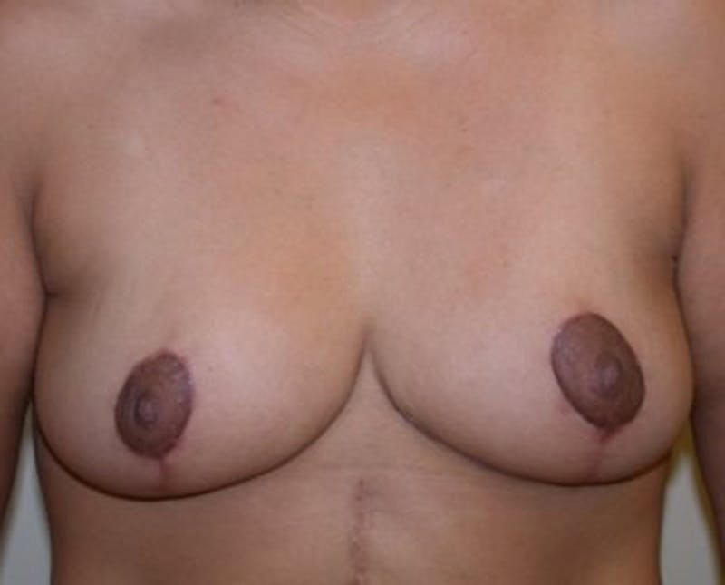 Breast Reduction Before & After Gallery - Patient 174150035 - Image 2