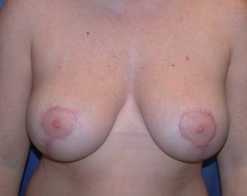 Breast Reduction Before & After Gallery - Patient 174160943 - Image 2