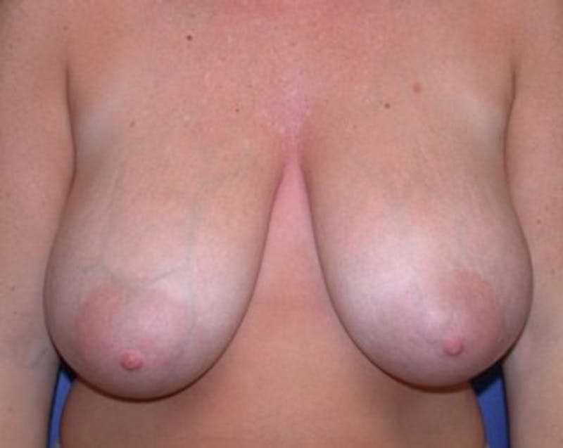 Breast Reduction Before & After Gallery - Patient 174160943 - Image 1