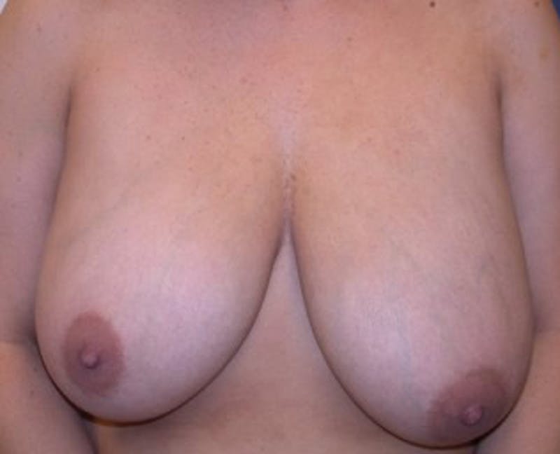 Breast Reduction Before & After Gallery - Patient 174160952 - Image 1