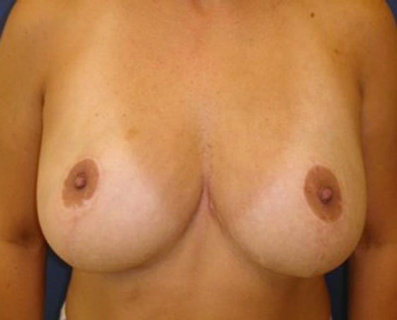 Breast Reduction Before & After Gallery - Patient 174160952 - Image 2