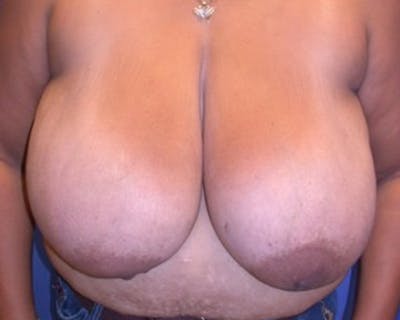 Breast Reduction Before & After Gallery - Patient 174160959 - Image 1