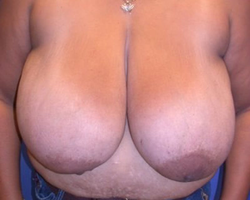 Breast Reduction Before & After Gallery - Patient 174160959 - Image 1