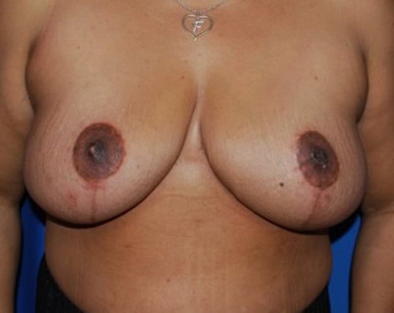 Breast Reduction Before & After Gallery - Patient 174160959 - Image 2