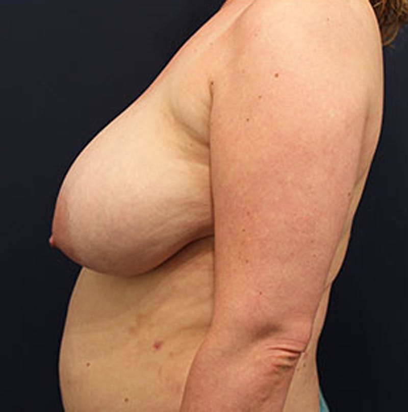 Breast Reduction Before & After Gallery - Patient 174160966 - Image 5