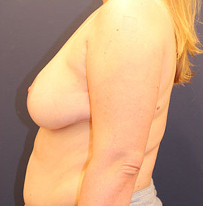 Breast Reduction Before & After Gallery - Patient 174160966 - Image 6