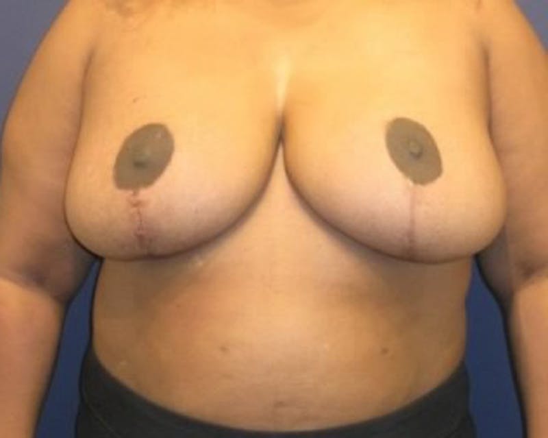 Breast Reduction Before & After Gallery - Patient 174160971 - Image 2