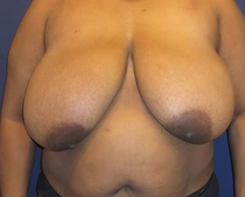 Breast Reduction Before & After Gallery - Patient 174160971 - Image 1