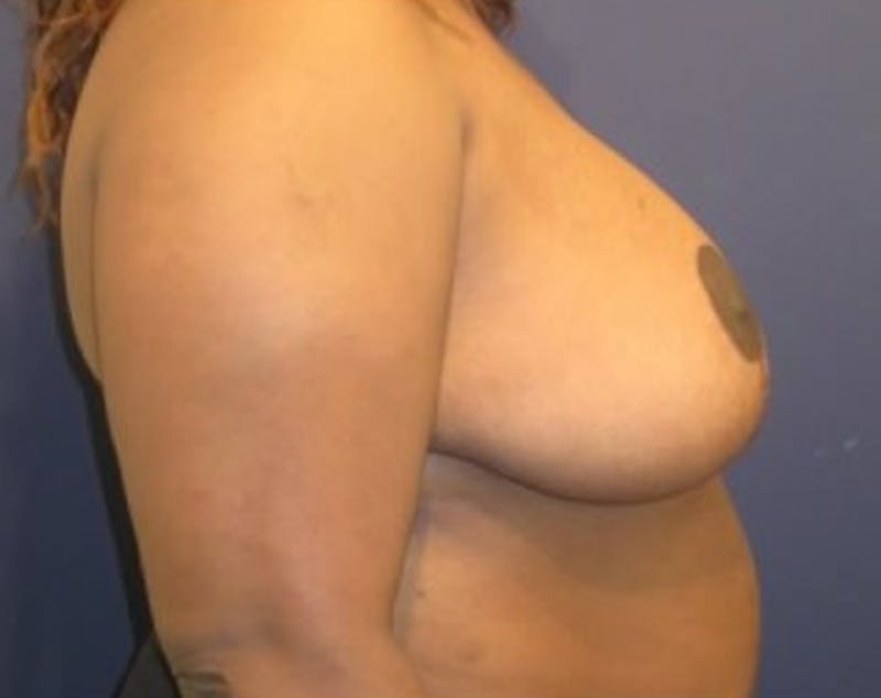 Breast Reduction Before & After Gallery - Patient 174160971 - Image 4
