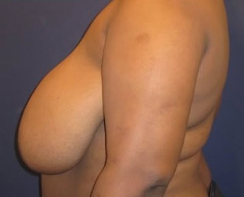 Breast Reduction Before & After Gallery - Patient 174160971 - Image 5
