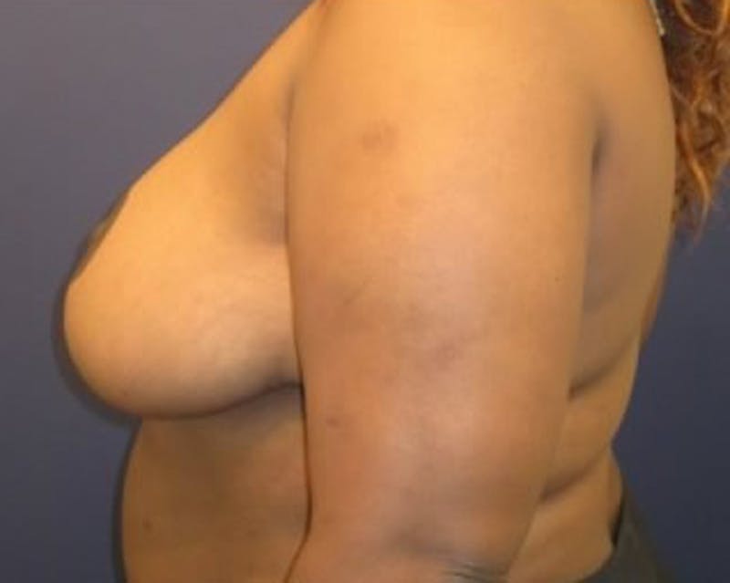 Breast Reduction Before & After Gallery - Patient 174160971 - Image 6