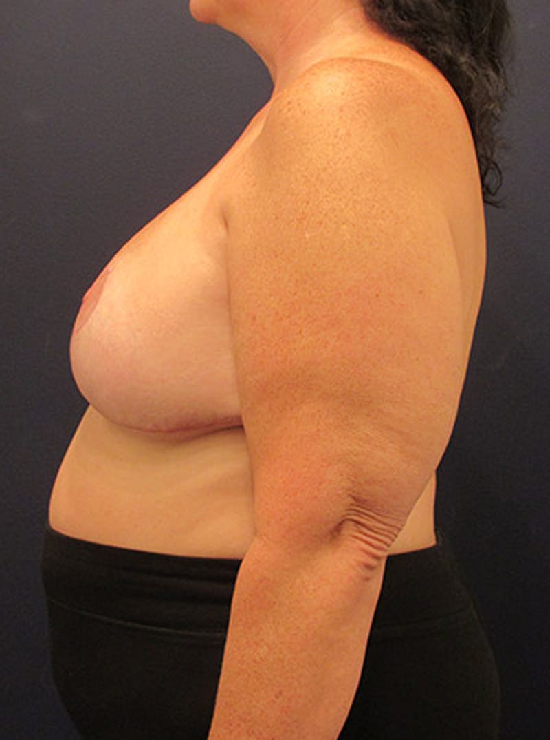 Breast Reduction Before & After Gallery - Patient 174162063 - Image 6