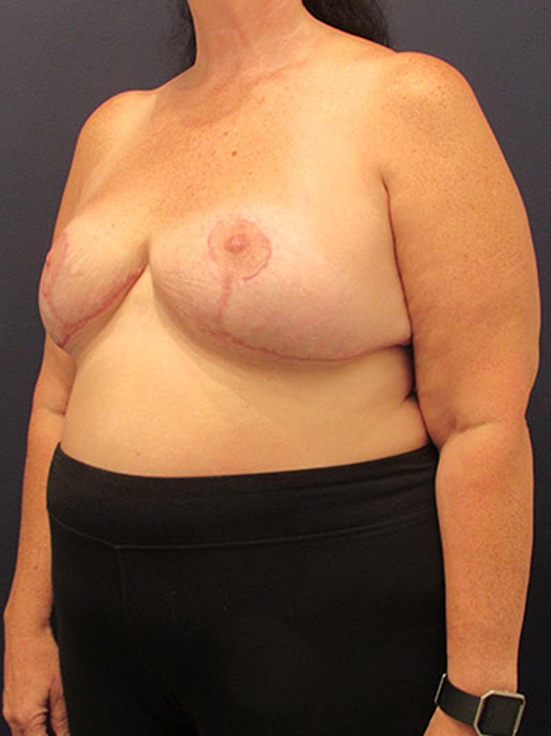 Breast Reduction Before & After Gallery - Patient 174162063 - Image 4
